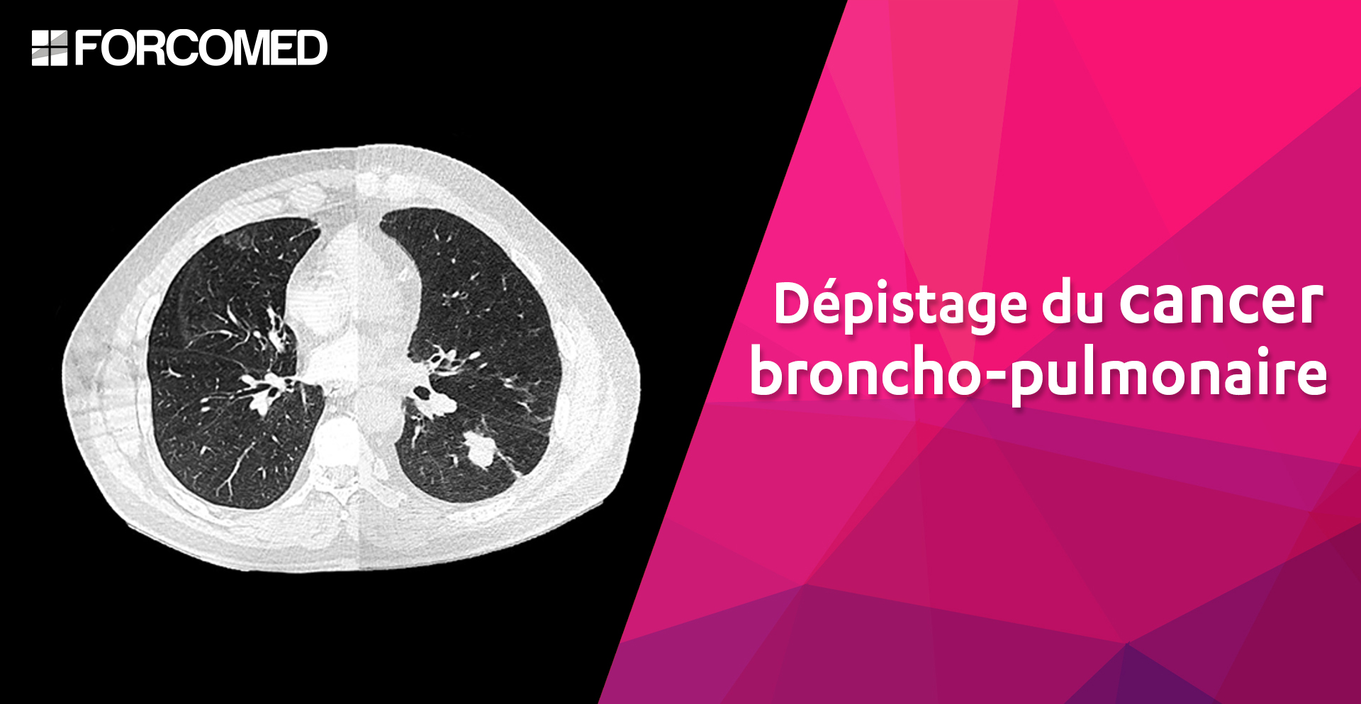 Dépistage cancer broncho-pulmonaire